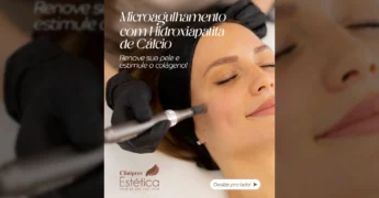 Mulher recebendo tratamento de microagulhamento com Hidroxiapatita de Cálcio na Cliniprev Estética em Cuiabá, cortesia de @cliniprevestetica