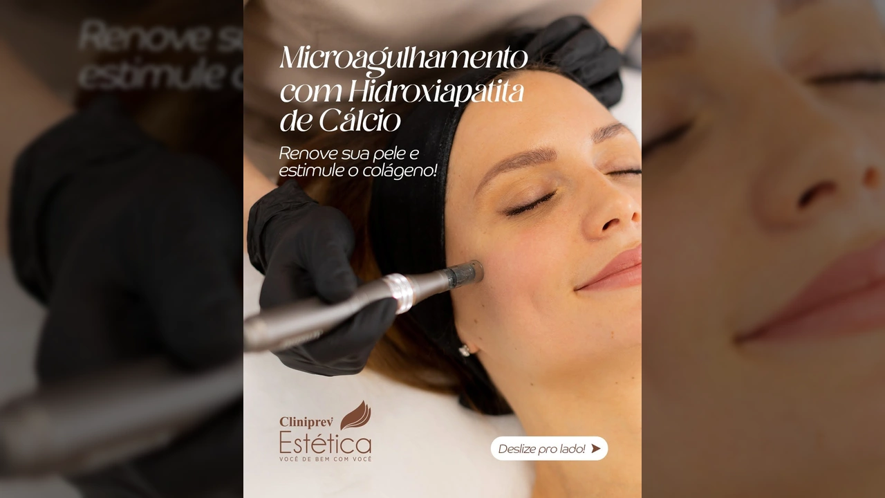 Mulher recebendo tratamento de microagulhamento com Hidroxiapatita de Cálcio na Cliniprev Estética em Cuiabá, cortesia de @cliniprevestetica